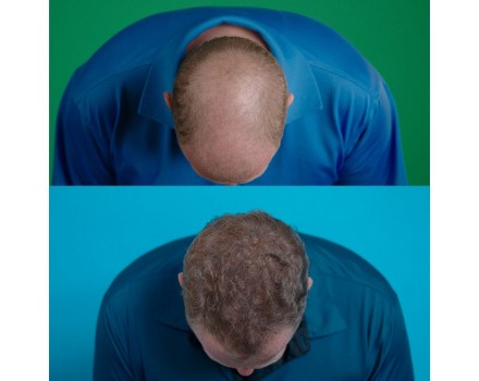 Velform Hair Grow Max 1+ 1 Grátis